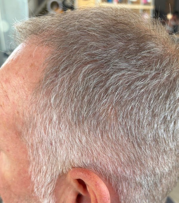 Hair at 12 weeks