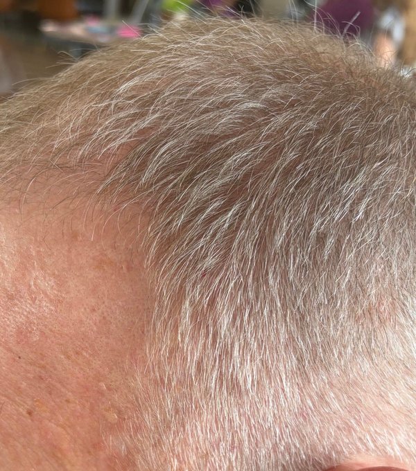 Hair at 4 weeks