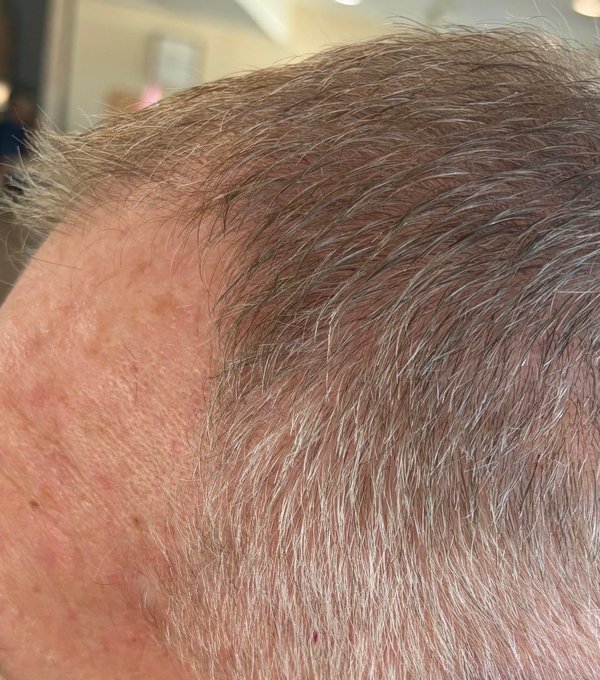 Hair at 8 weeks