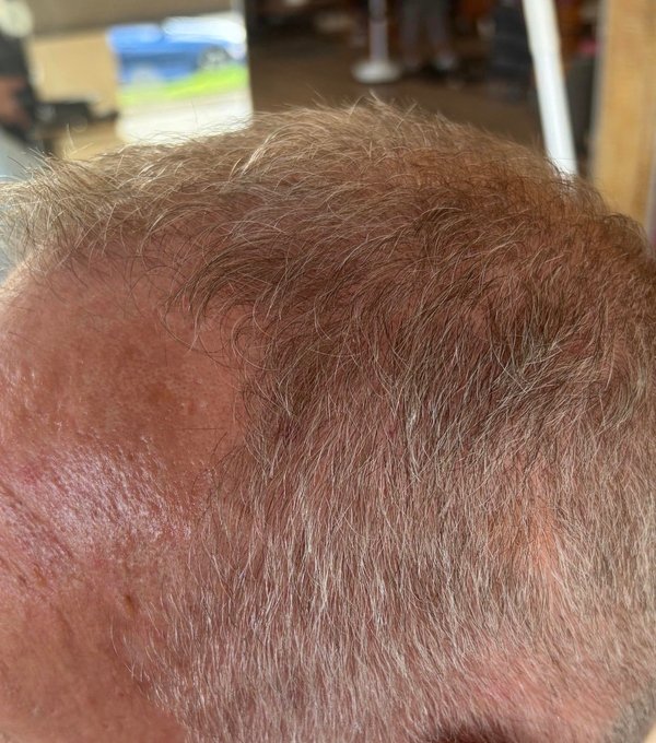 Hair at baseline